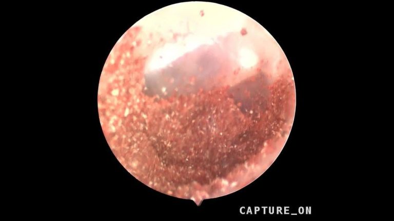 cham-soc-tai-mui-hong-tre-voi-taka